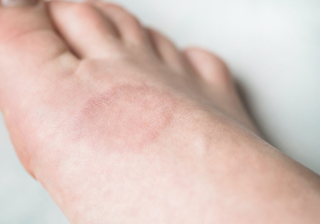 Common Vitamins and Supplements for Treating Granuloma Annulare Natural Health News