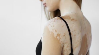 Discover the Best Natural Remedies for Tinea Versicolor