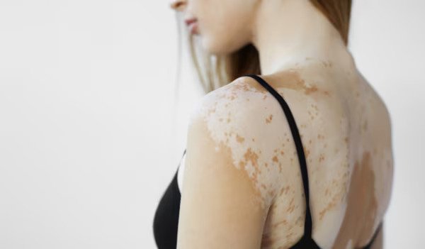 Discover the Best Natural Remedies for Tinea Versicolor