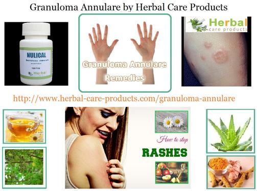 Herbal Remedies for Granuloma Annulare