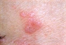 Lichen Planus