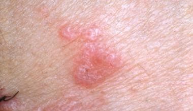 Lichen Planus