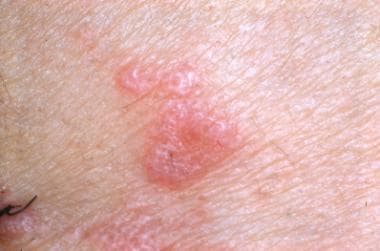 Lichen Planus