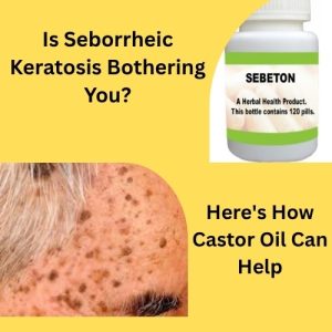Is Seborrheic Keratosis Bothering You