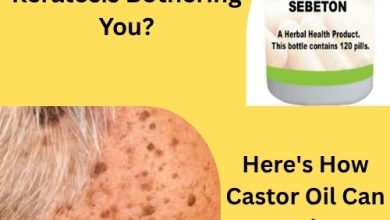 Is Seborrheic Keratosis Bothering You