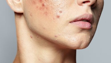 Actinic Lichen Planus Face