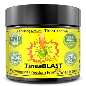 Tinea-Versicolor-Cream