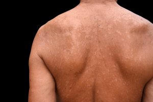 Tiversical: Tinea Versicolor Herbal Supplement
