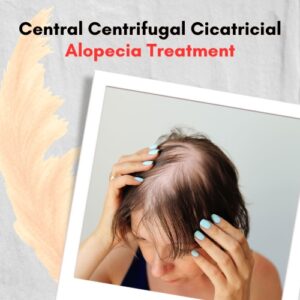 Central Centrifugal Cicatricial Alopecia Treatment (2)