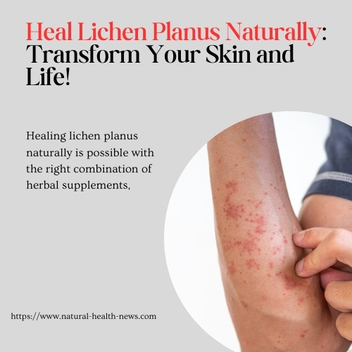 Heal Lichen Planus Naturally