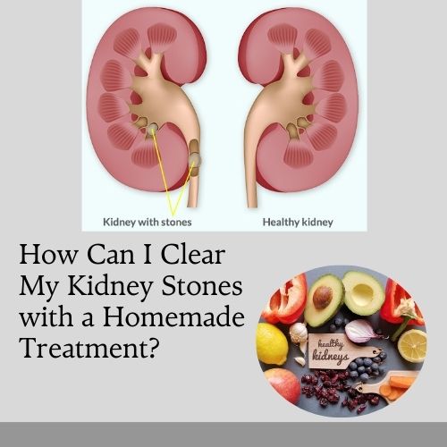 How Can I Clear My Kidney Stones with a Homemade Treatment
