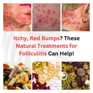 Natural Treatments for Folliculitis
