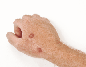 Actinic Keratosis 6