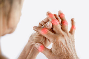 Arthritis and Joint Pain 2
