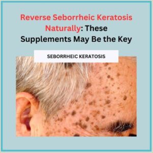 Reverse Seborrheic Keratosis Naturally