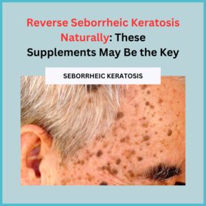 Reverse Seborrheic Keratosis Naturally
