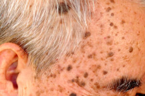 seborrheic keratosis 1