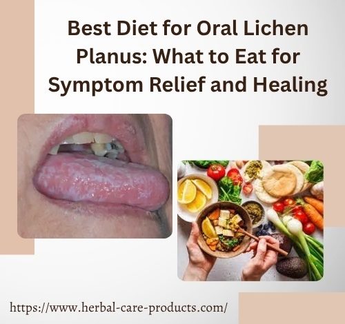 Best Diet for Oral Lichen Planus
