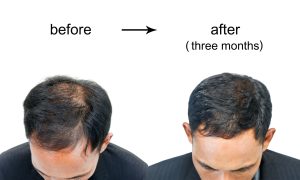 Best-Hair-Loss-Treatments-for-Men