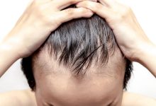 Does-Hair-Replacement-Have-Any-Side-Effects.jpg
