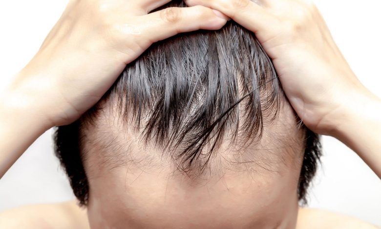 Does-Hair-Replacement-Have-Any-Side-Effects.jpg