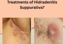 Effective Treatments of Hidradenitis Suppurativa