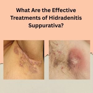 Effective Treatments of Hidradenitis Suppurativa