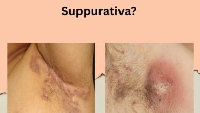 Effective Treatments of Hidradenitis Suppurativa