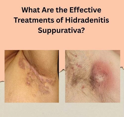 Effective Treatments of Hidradenitis Suppurativa