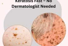How to Get Rid of Seborrheic Keratosis Fast
