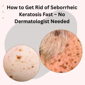 How to Get Rid of Seborrheic Keratosis Fast