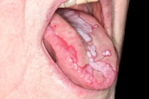Oral Lichen Planus 