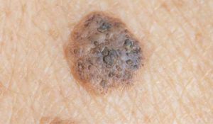 Seborrheic Keratosis 1