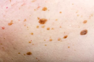 Seborrheic Keratosis 2