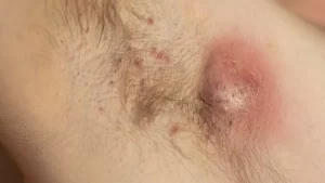 Treatments of Hidradenitis Suppurativa 3