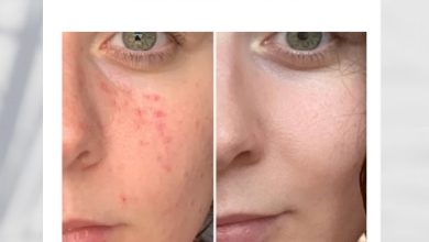 What is the Best Way to Get Clear Skin