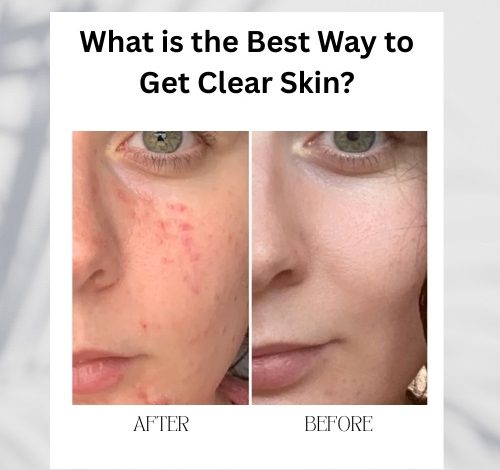 What is the Best Way to Get Clear Skin