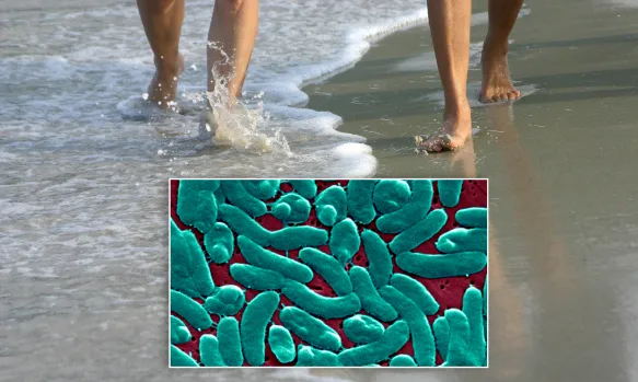Flesh Eating Bacteria in New Jersey