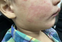 Measles Outbreak in Austin