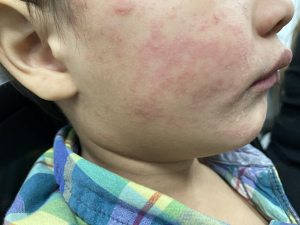 Measles Outbreak in Austin