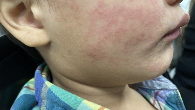 Measles Outbreak in Austin
