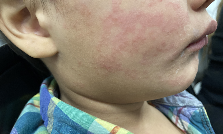 Measles Outbreak in Austin