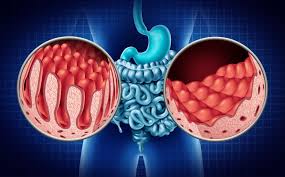 Coeliac Disease