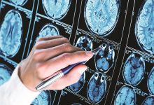 Is Lithium Orotate the Ultimate Brain Supplement of 2025