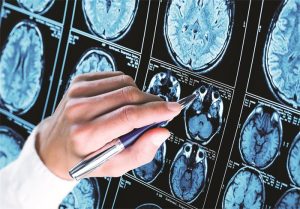 Is Lithium Orotate the Ultimate Brain Supplement of 2025
