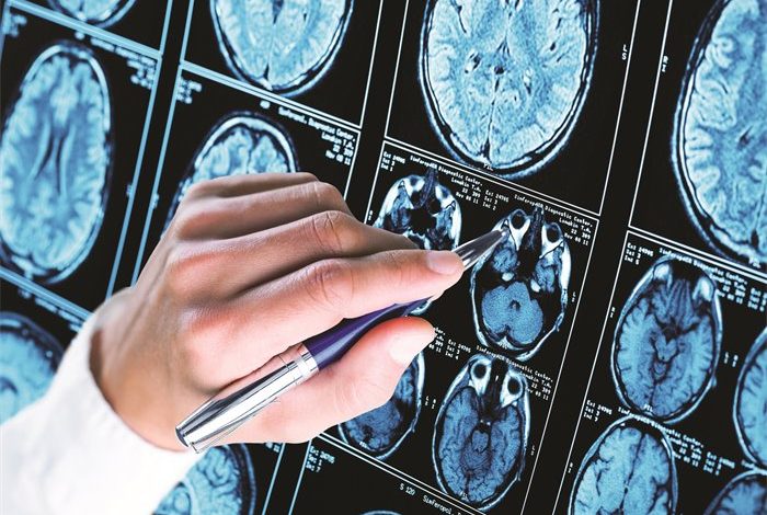 Is Lithium Orotate the Ultimate Brain Supplement of 2025