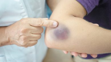 7 Shocking Reasons You Bruise So Easily