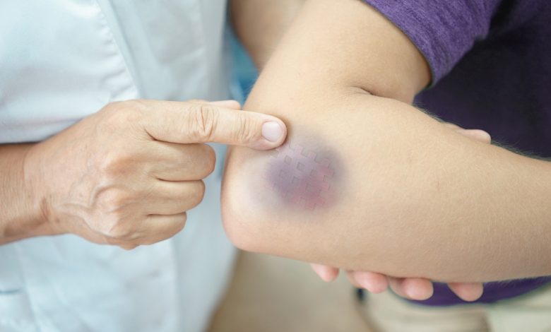 7 Shocking Reasons You Bruise So Easily
