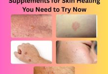 5 Powerful Herbal Supplements for Skin Healing You Need to Try Now