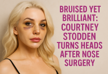 Bruised Yet Brilliant: Courtney Stodden Turns Heads After Nose Surgery